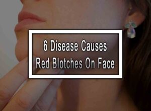 6 Disease Causes Red Blotches On Face