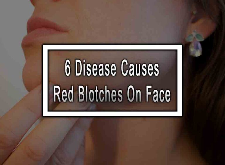 6-disease-causes-red-blotches-on-face