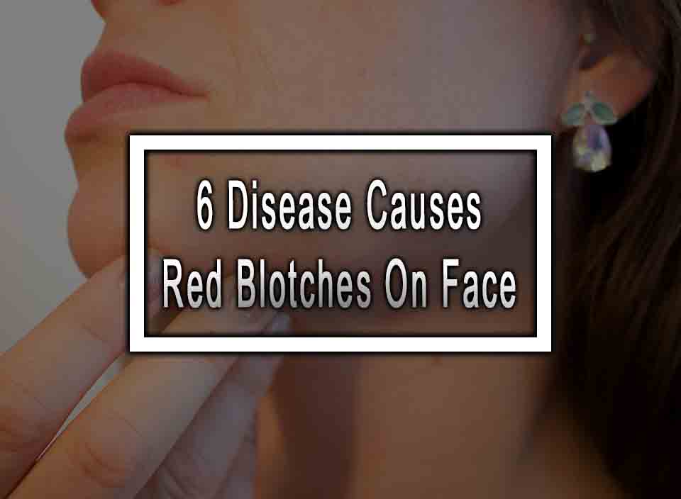 6 Disease Causes Red Blotches On Face