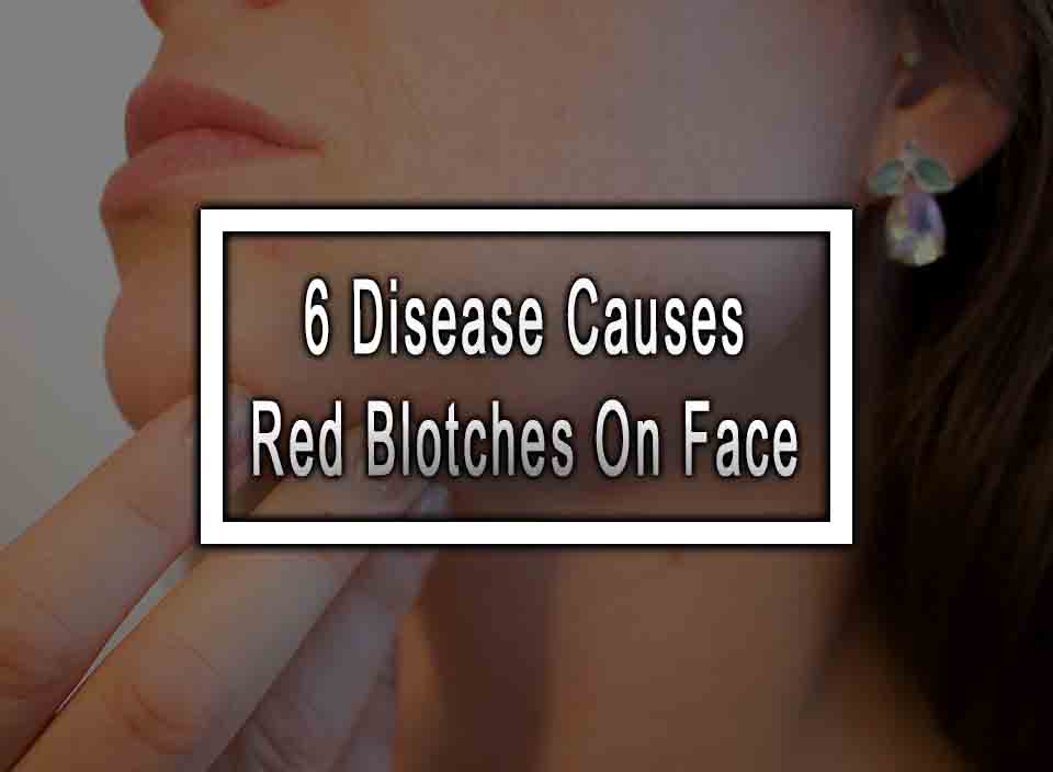 6-disease-causes-red-blotches-on-face