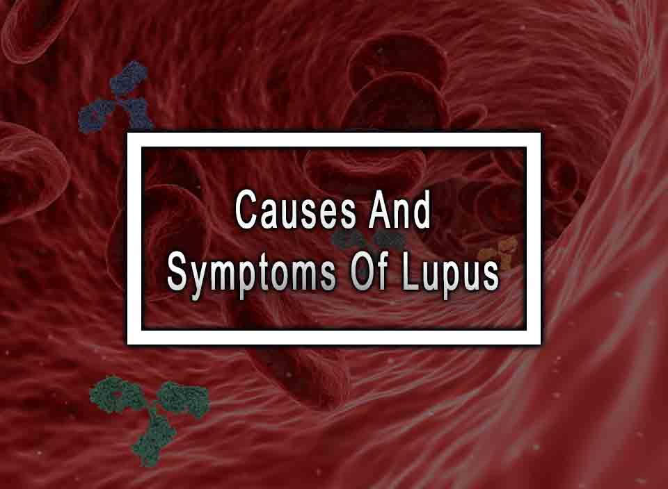 Causes And Symptoms Of Lupus Hanapph 