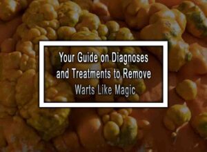 Your Guide on Diagnoses and Treatments to Remove Warts Like Magic