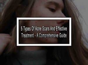 5 Types Of Acne Scars And Effective Treatment - A Comprehensive Guide