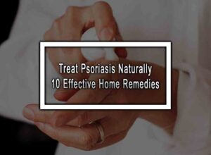 Treat Psoriasis Naturally - 10 Effective Home Remedies